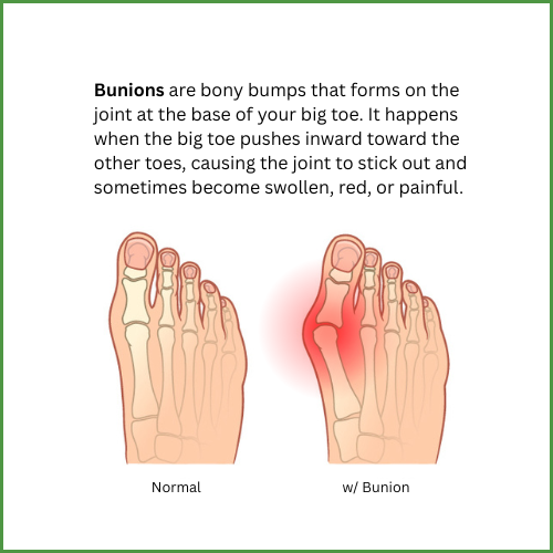 Bunions