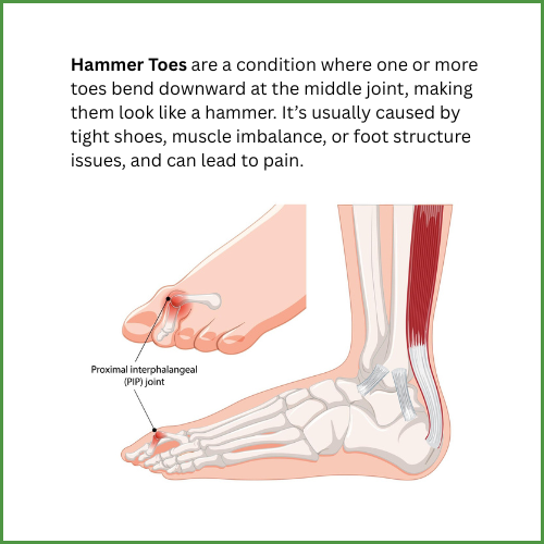 Hammertoes